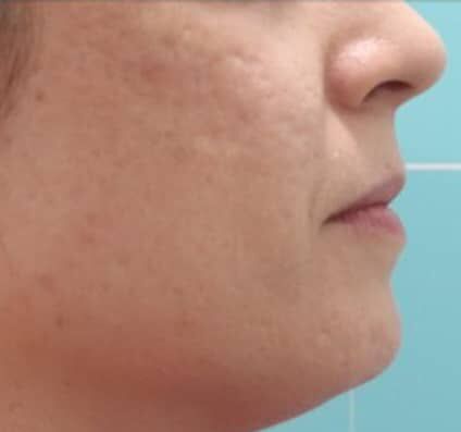 Acne & Acne Scars - After