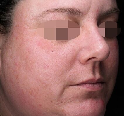 Bio-Boost Skin Rejuvenation - After