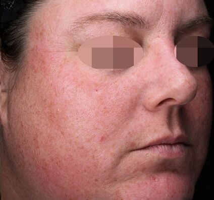 Bio-Boost Skin Rejuvenation - Before