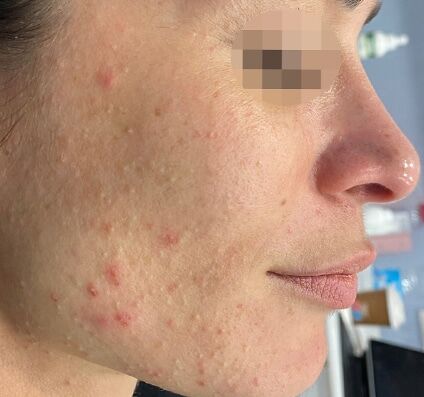 Active Acne Treatment - Before