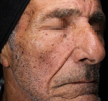 Skin Texture & Tone - Before