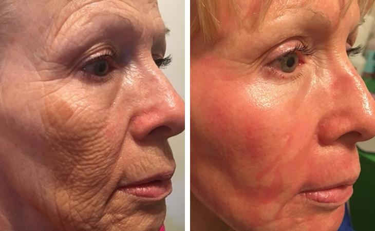 Skin Resurfacing